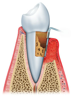 Zahnfleischentzündung