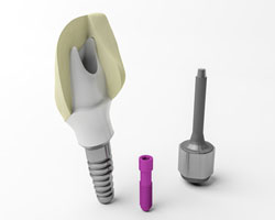 Die Teile, die für ein Zahnimplantat nötig sind