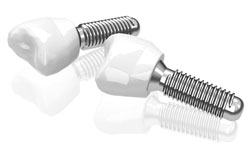 Zahnersatz bereit zur Implantation